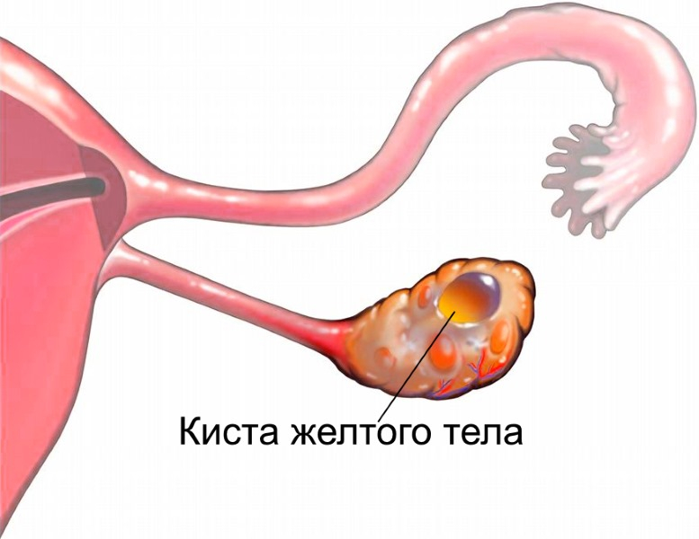 что такое желтое тело в гинекологии / что такое жёлтое тело в гинекологии